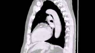 Lytic lesions in multiple myeloma lower res [upl. by Afatsom]