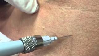 Treating angiomas amp DPNs on the chest with electrocautery For medical education NSFE [upl. by Dailey]