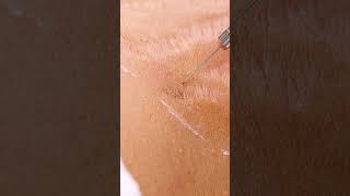 Up close view of how laser stretch mark removal works 😯 shorts [upl. by Dedrick]