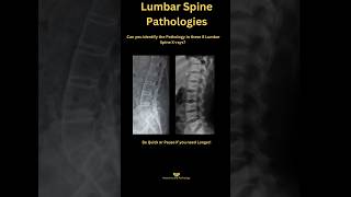 Lumbar Spine Pathologies Rapid Fire Xray Quiz 🔥 medicalimaging medicaltest radiography xray [upl. by Guarino]