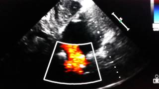 Echocardiogram  inetrarial communication superior sinus venosus [upl. by Akahs]