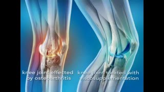 Knee Injection with Euflexxa Non surgical Knee Pain Relief الحقن بمفصل الركبة [upl. by Alleyne999]