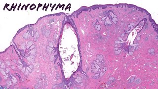 Rhinophyma large nose due to severe rosacea plus Demodex mites [upl. by Ellerol589]