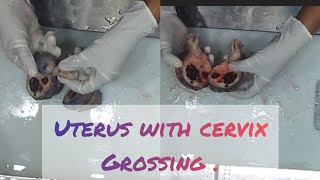 uterus with cervix spceimen grossing video😨 uterusproblem cervix ovariancyst cyst fibroadenoma [upl. by Donnie145]