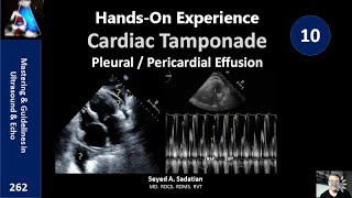 HandsOn Experience 10 Cardiac Tamponade Pleural  Pericardial Effusion [upl. by Nollad247]