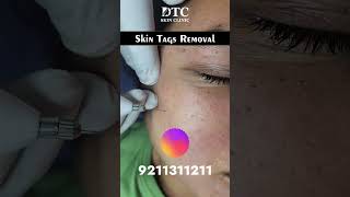 Skin Tags Removal Treatment Dr Rohit Goel [upl. by Kyriako689]