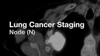 Lung Cancer Staging  Node N [upl. by Aseela882]