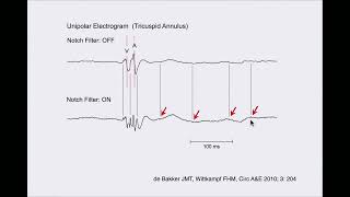 Timing Bipolar and Unipolar Atrial Electrograms Part II with Warren quotSonnyquot Jackman MD [upl. by Laks]