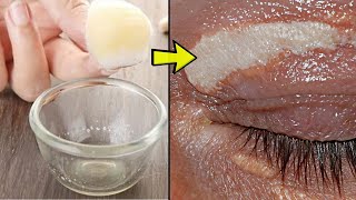 Xanthelasma Removal at Home  5 Remedies for removing Xanthelasma on the Upper and Lower Eyelids [upl. by Rey482]