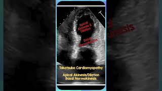 Takotsubo Cardiomyopathy Echo REBELEM FOAMus MedEd TakotsuboCardioMyopathy [upl. by Norek]