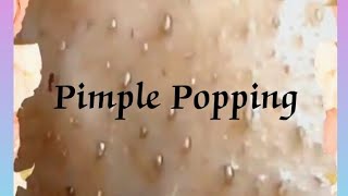 Pimple amp Blackheads Popping  37 [upl. by Westerfield424]