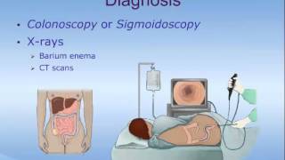 Ulcerative Colitis [upl. by Nosnaj]