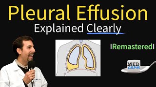 Pleural Effusions  Causes Diagnosis Symptoms Treatment [upl. by Atteve247]