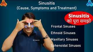 Sinusitis on Sinuses  Types and Treatment By Dr Puspendra [upl. by Athalla]