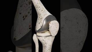 Total Knee Replacement [upl. by Sorce]