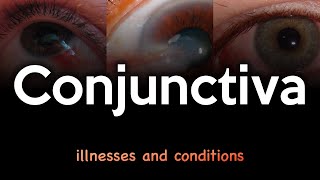 Conjunctiva Illnesses and Conditions [upl. by Ielhsa]