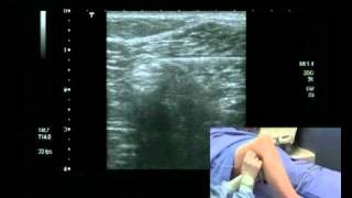 Popliteal Block Ultrasound guided  lateral approach [upl. by Bollay80]