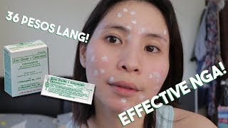 How To Dry Pimples in 3 Days  Affordable Acne Treatment [upl. by Ynned55]