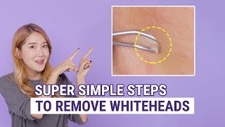 How To Remove Whiteheads  The Best Whitehead Removal amp Prevention Box [upl. by Rratsal]