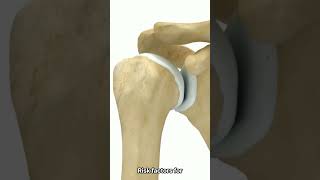 Shoulder Osteoarthritis  Causes and Treatments 어깨 관절염 원인과 치료법 [upl. by Orna]