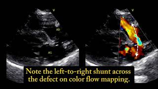 Ostium secundum atrial septal defect a 6 monthold cat 🐱 [upl. by Aihsenad667]