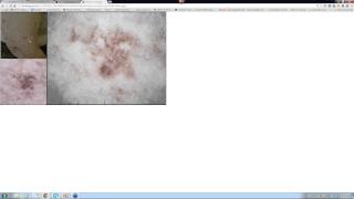 2013 12 08 11 13 Lentiginous melanoma [upl. by Ardaed]