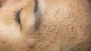 ACNE TREATMENT VU QUYNH MI Acne On Teens Cheek 2024 [upl. by Eelarbed]