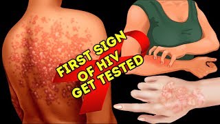 What Is Usually The First Sign Of HIV [upl. by Reggie]