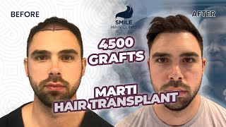 Transformative Hair Transplant Journey  12 Months Before amp After  4500 Grafts [upl. by Mariquilla584]