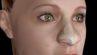 Bulbous Large Nasal Tip Nose Job Rhinoplasty [upl. by Frum]