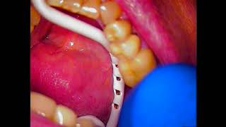 DENTAL IMPLANT RESCUE  REMOVAL OF A BROKEN ABUTMENT AND SCREW BY DR GERRY CUOMO [upl. by Argyres274]