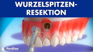 Wurzelspitzenresektion © [upl. by Eittel133]