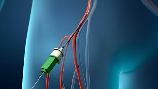 Coronary Angioplasty Femoral Access [upl. by Sivra]