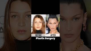 Bella hadid before and after plastic surgery [upl. by Barb270]