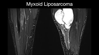 Myxoid Liposarcoma [upl. by Lienahs877]