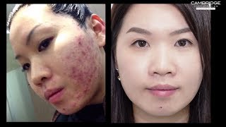 NeoGen Plasma for Acne by Cambridge Therapeutics  Calvy Ling [upl. by Hashim]