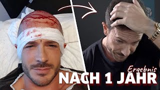 Ein Jahr nach meiner Haartransplantation  Ergebnis amp Fazit [upl. by Yeoz431]