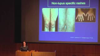 Lupus The Skin amp Hair  Dr Abby Macbeth East Anglia Lupus Info Day Oct 2013 [upl. by Nas]