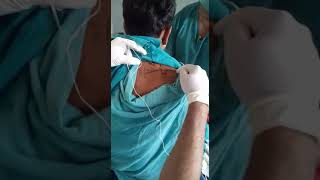 SUPRASCAPULAR NERVE BLOCK PNS GUIDED [upl. by Ssalguod]