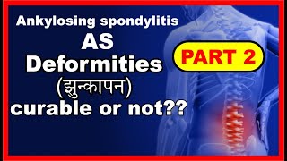 How to cure Ankylosing spondylitis [upl. by Lawley]