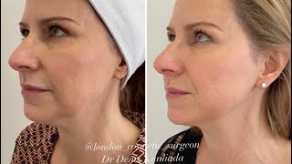 Endolift Best laser for non surgical face lift and neck lift [upl. by Niwhsa639]