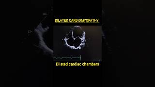 Dilated Cardiomyopathycardiomyopathymyocarditisechoheartfailure heartfunctionpericarditis [upl. by Icnarf]