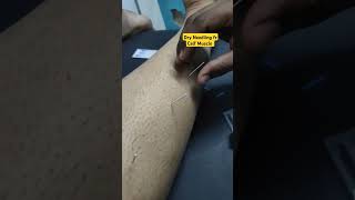 Dry Needling for Calf muscle acupuncture doctor physiotherapy health dryneedling viralvideo [upl. by Yenroc]