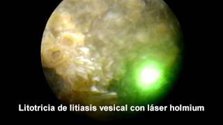 Litotricia litiasis vesical laser holmium Holmium laser lithotripsy in bladder stone [upl. by Haukom]