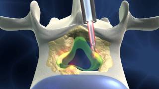 Fullendoscopic spinal surgery for spinal stenosis dorsal approach [upl. by Fillander]