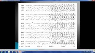 Epilepsy 101 [upl. by Tutto]