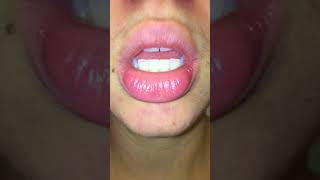 exfoliative cheilitis  day 0 pre treatment  tacrolimus amp burts bees wax hand salve [upl. by Airres]