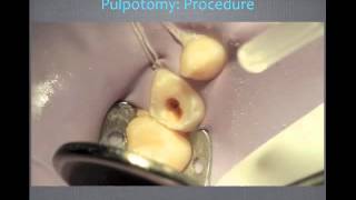 Pulp Therapy and Primary Tooth Pulpotomy  Video Review [upl. by Harat21]