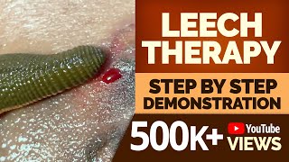 LEECH THERAPY Step by Step Demonstration [upl. by Namron779]