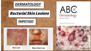 DERMATOLOGY Bacterial skin lesions  impetigo bullos nonbullos ecthyma derma impetigo [upl. by Henarat]